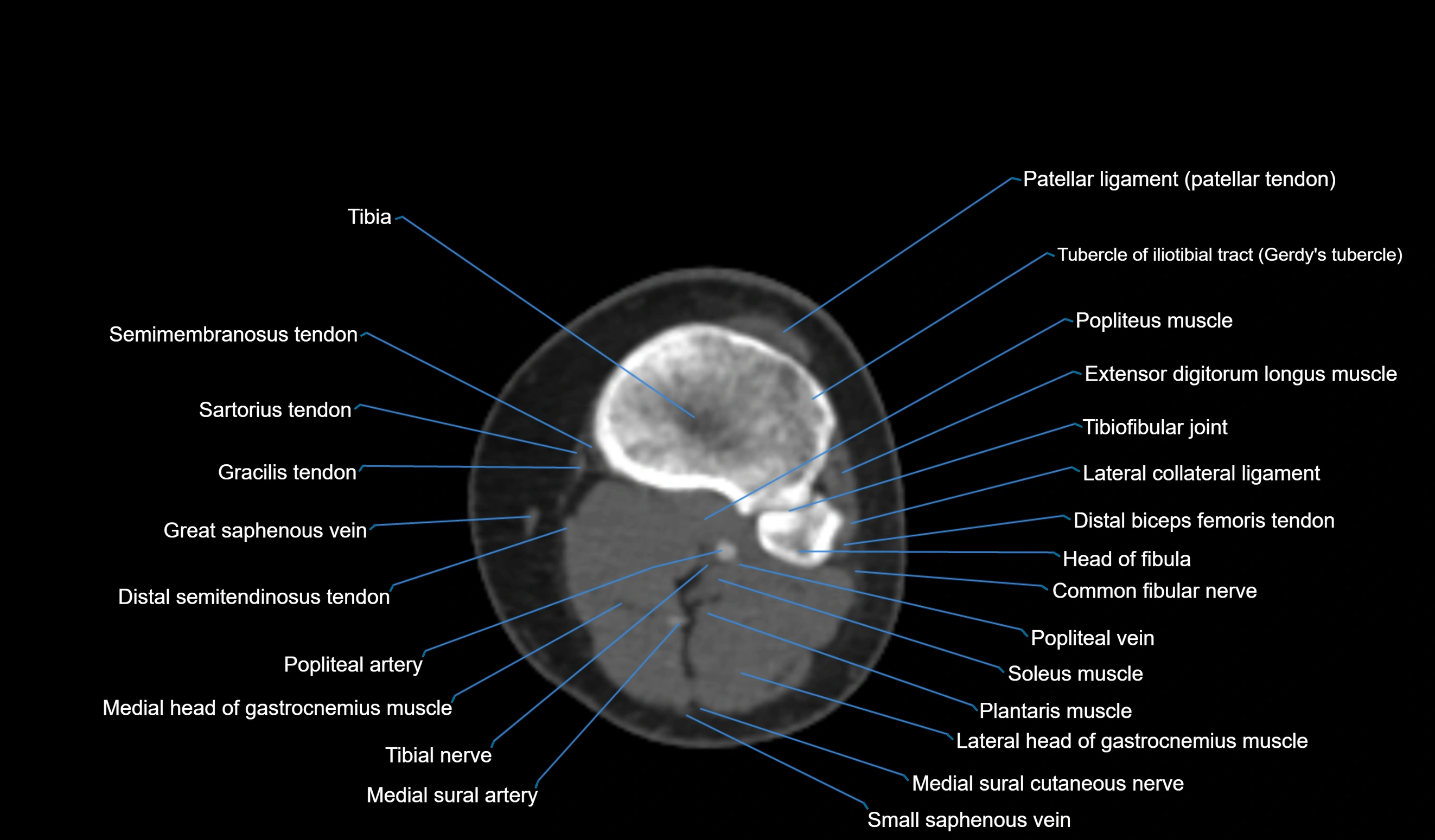 CT knee axial cross sectional anatomy labelled image-00044.webp